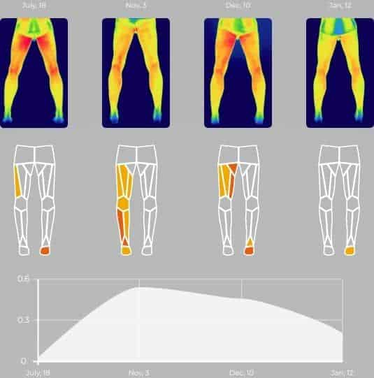 Termografía en dolor muscular de piernas en corredor