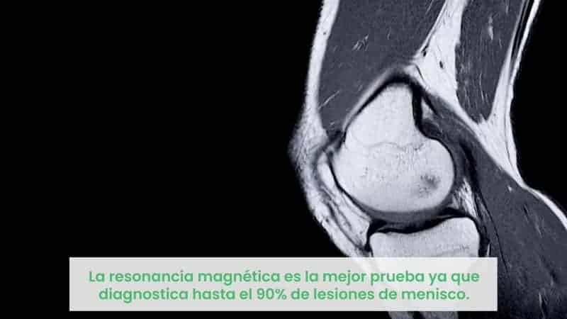 Rotura de menisco radiografía y resonancia pruebas complementarias 
