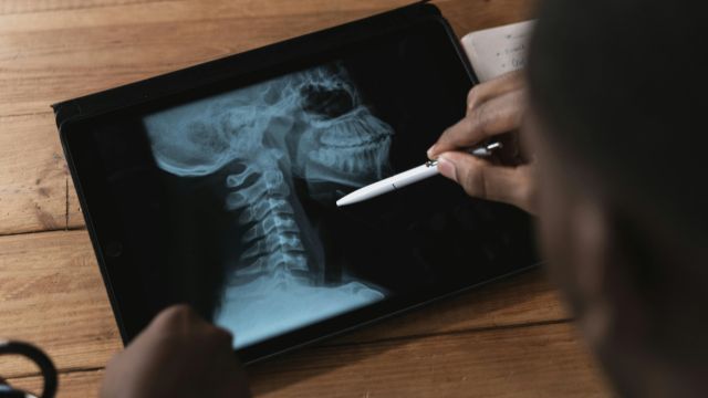 Anatomía de la columna cervical mostrando la lordosis cervical normal y su alineación fisiológica en Clínicas H3 Serrano, fisioterapia cervical en Madrid