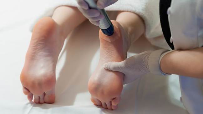 Aplicación de ondas de choque en el talón para el tratamiento del espolón calcáneo