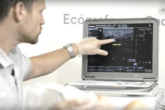 Ecografía del pie donde se observa un espolón calcáneo en el hueso del talón